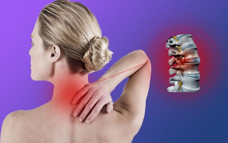 Zapalenie kręgosłupa z osteochondrozą szyjki macicy
