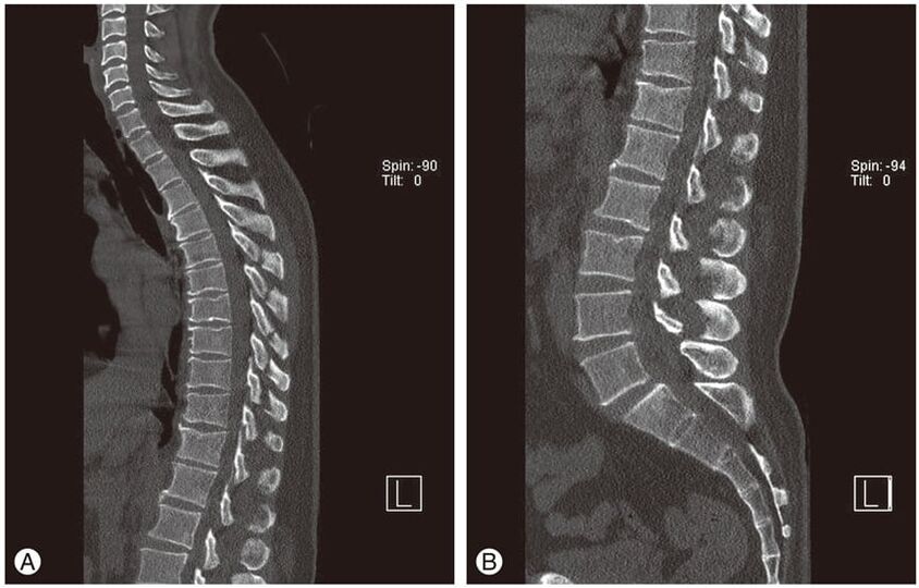 Deformacje krążków międzykręgowych na obrazach MRI w osteochondrozie klatki piersiowej