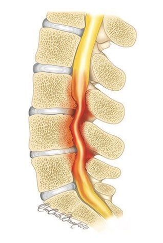 W przypadku osteochondrozy kręgosłupa piersiowego dochodzi do ucisku kanału kręgowego