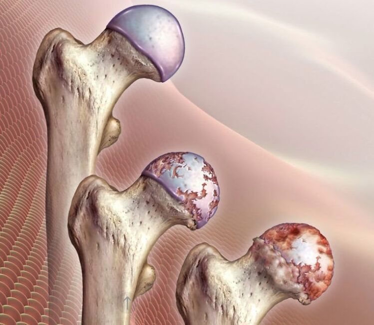 Artroza stawu biodrowego w różnym stopniu