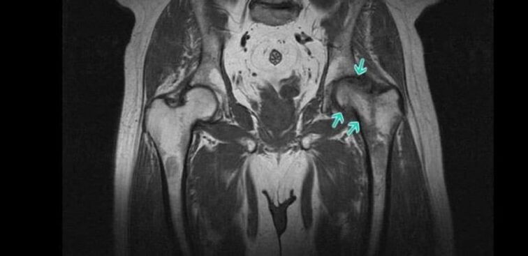 Choroba zwyrodnieniowa stawu biodrowego w MRI