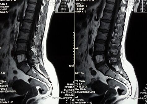 MRI kręgosłupa lędźwiowo-krzyżowego w diagnostyce bólu krzyża